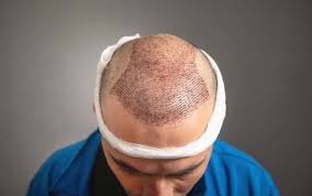 The Art OF Choosing The Best Hair Transplant Clinic